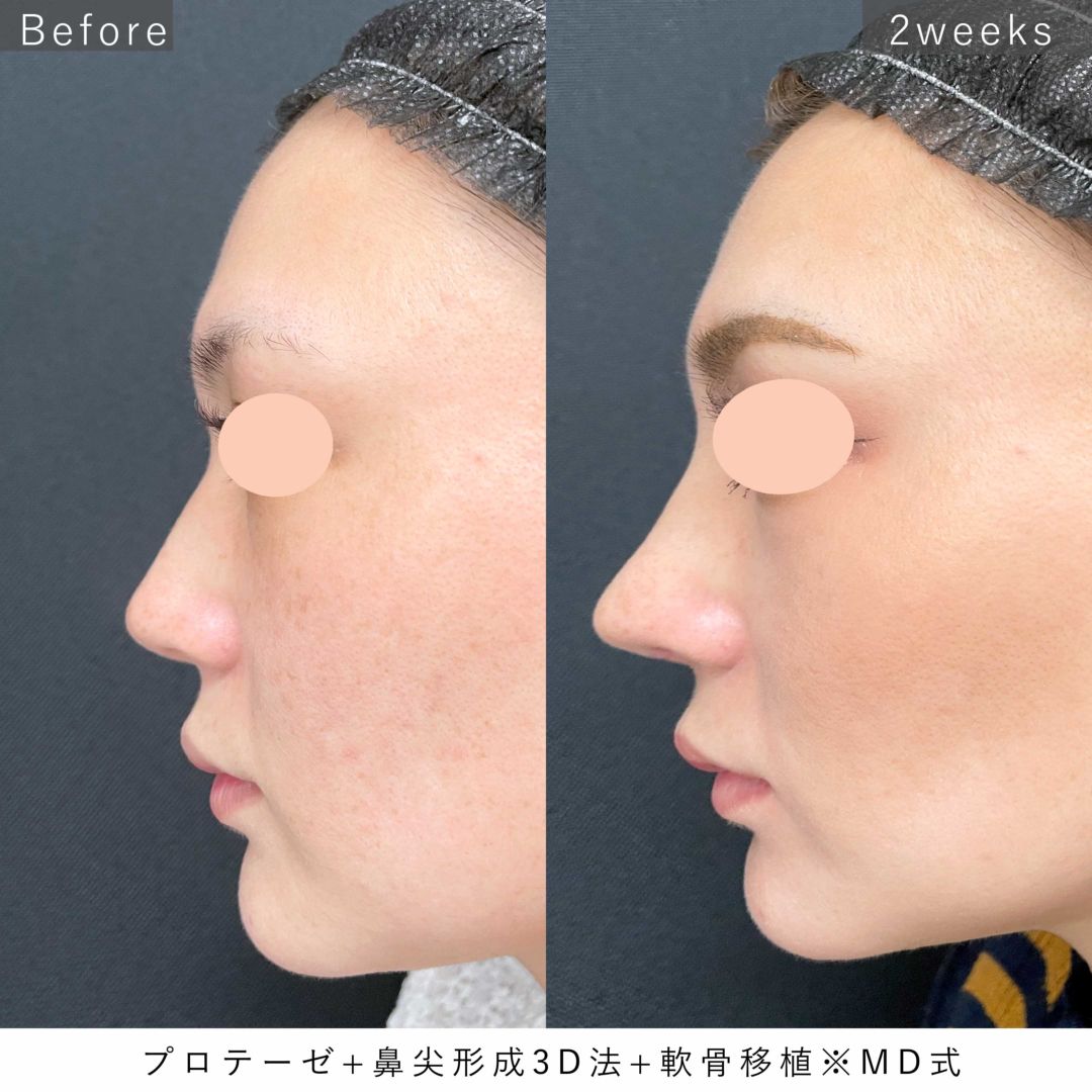 プロテーゼと鼻尖形成と軟骨移植で鼻が高くなった2週間後の症例
