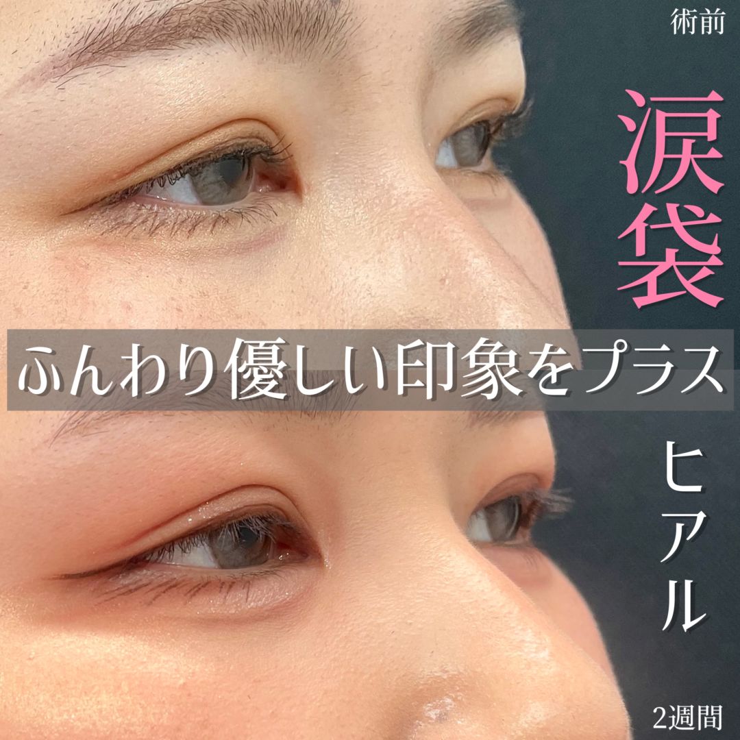 20代女性の涙袋ヒアルロン酸の症例