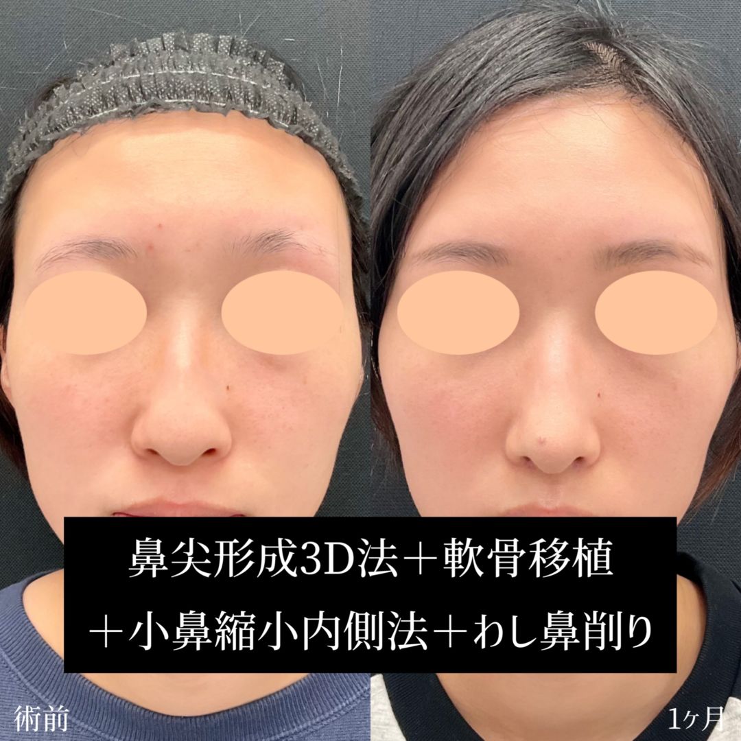 わし鼻のダウンタイムの経過の症例写真
