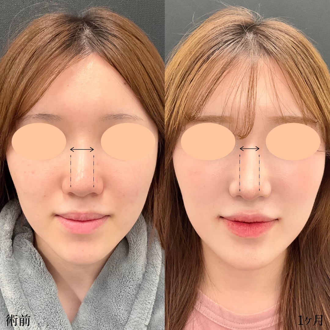 鼻尖形成と軟骨移植の症例
