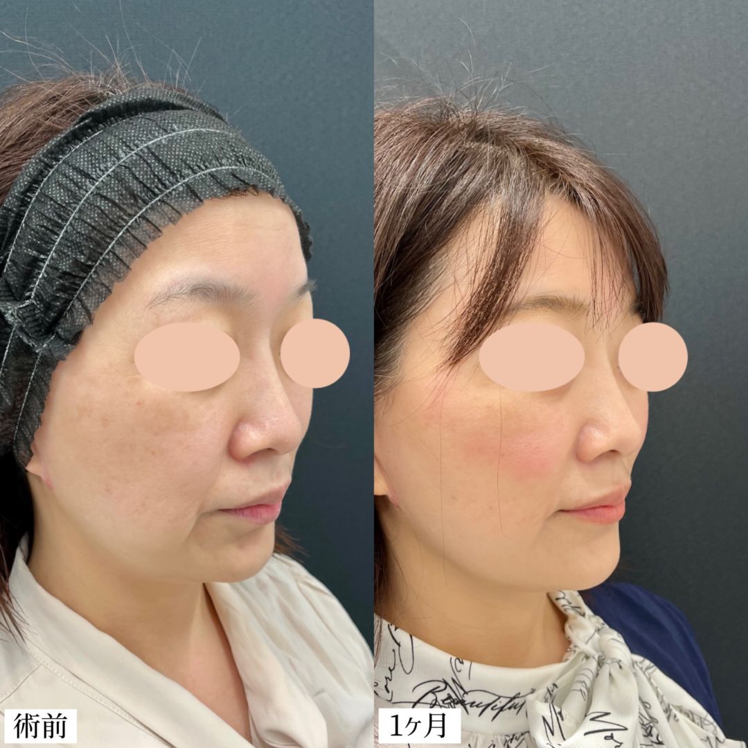 糸リフトの経過の症例写真