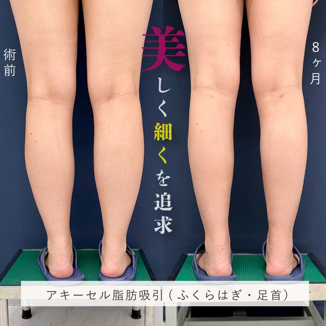 ふくらはぎの脂肪吸引とボトックス注射の８ヶ月の症例写真