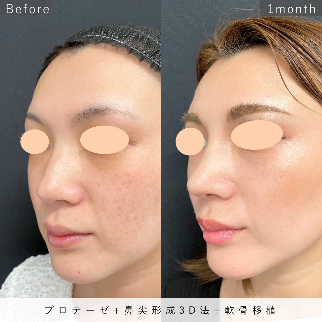 プロテーゼと鼻尖形成3D法をＭＤ式で行った30代女性の症例写真