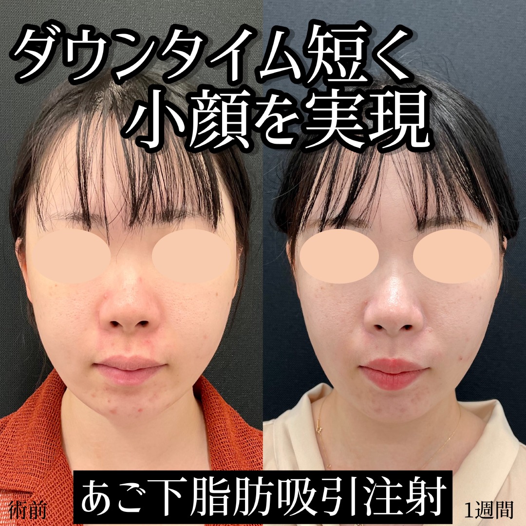 ダウンタイム短く小顔を実現