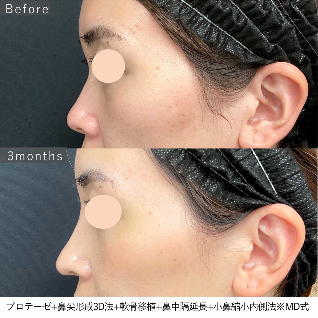プロテーゼと鼻尖形成3D法と軟骨移植と鼻中隔延長と小鼻縮小内側法とMD式の3ヶ月後の症例