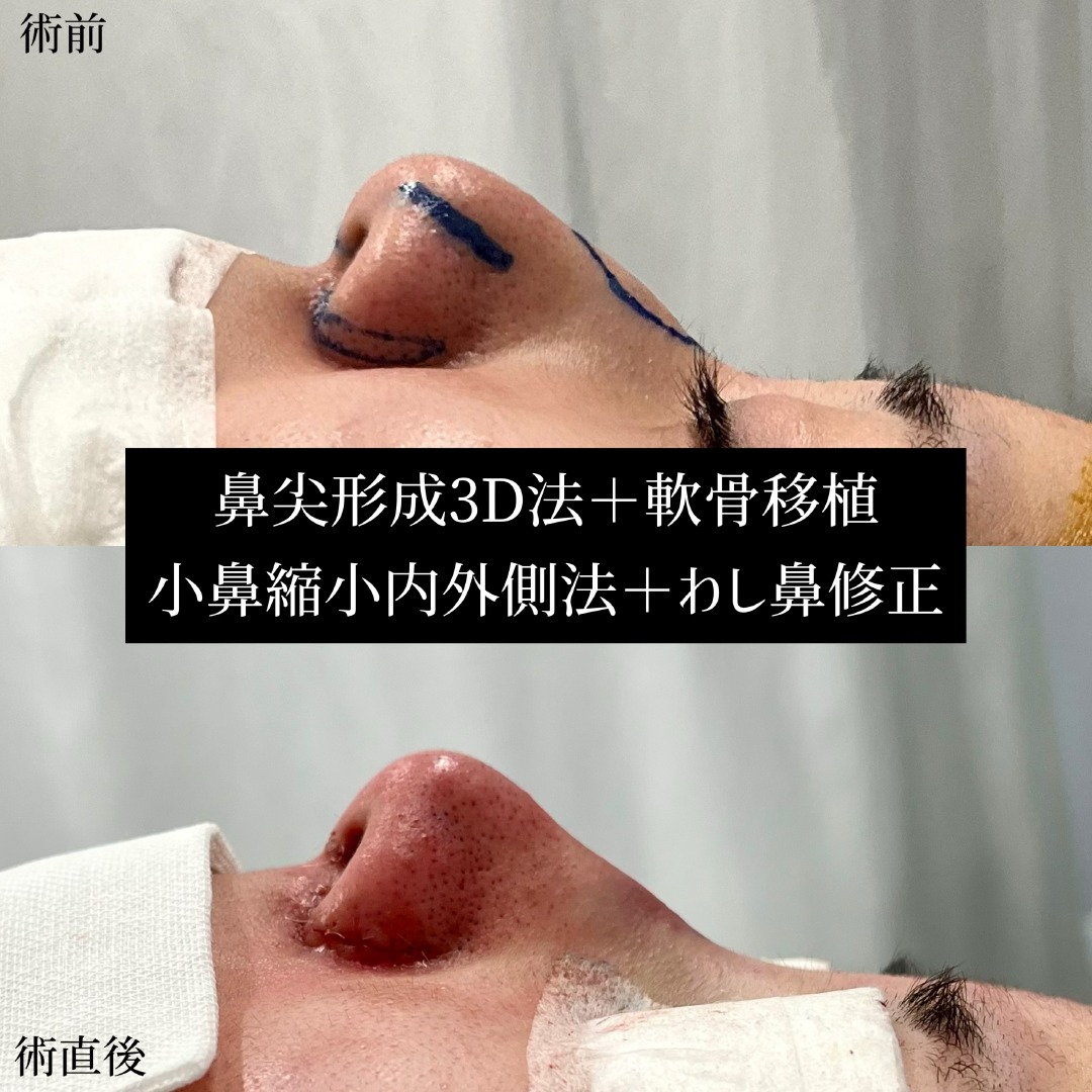 理想の鼻の形に