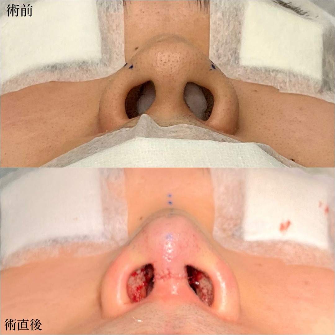 20代男性の鼻尖形成と軟骨移植の症例