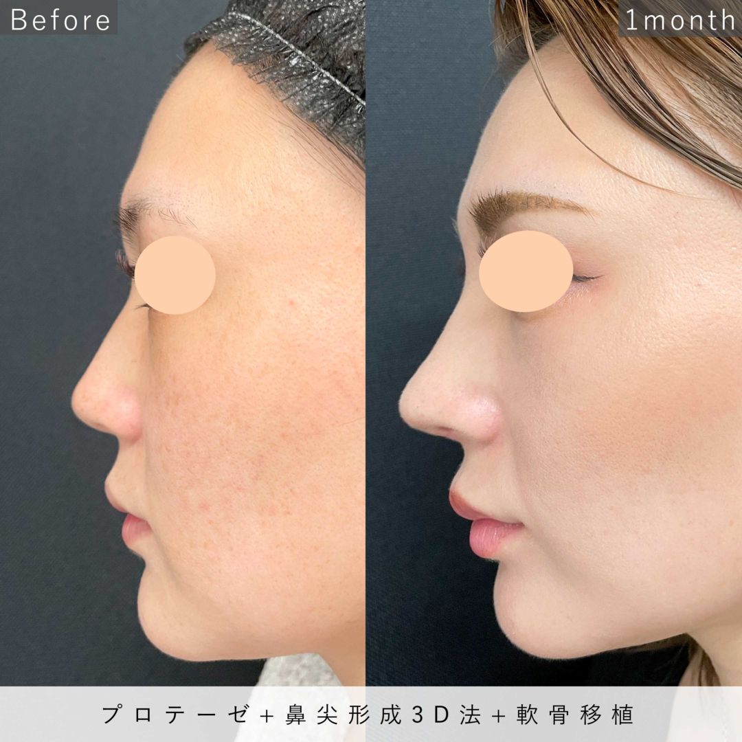 プロテーゼと鼻尖形成3D法をＭＤ式で行った20代女性の症例写真
