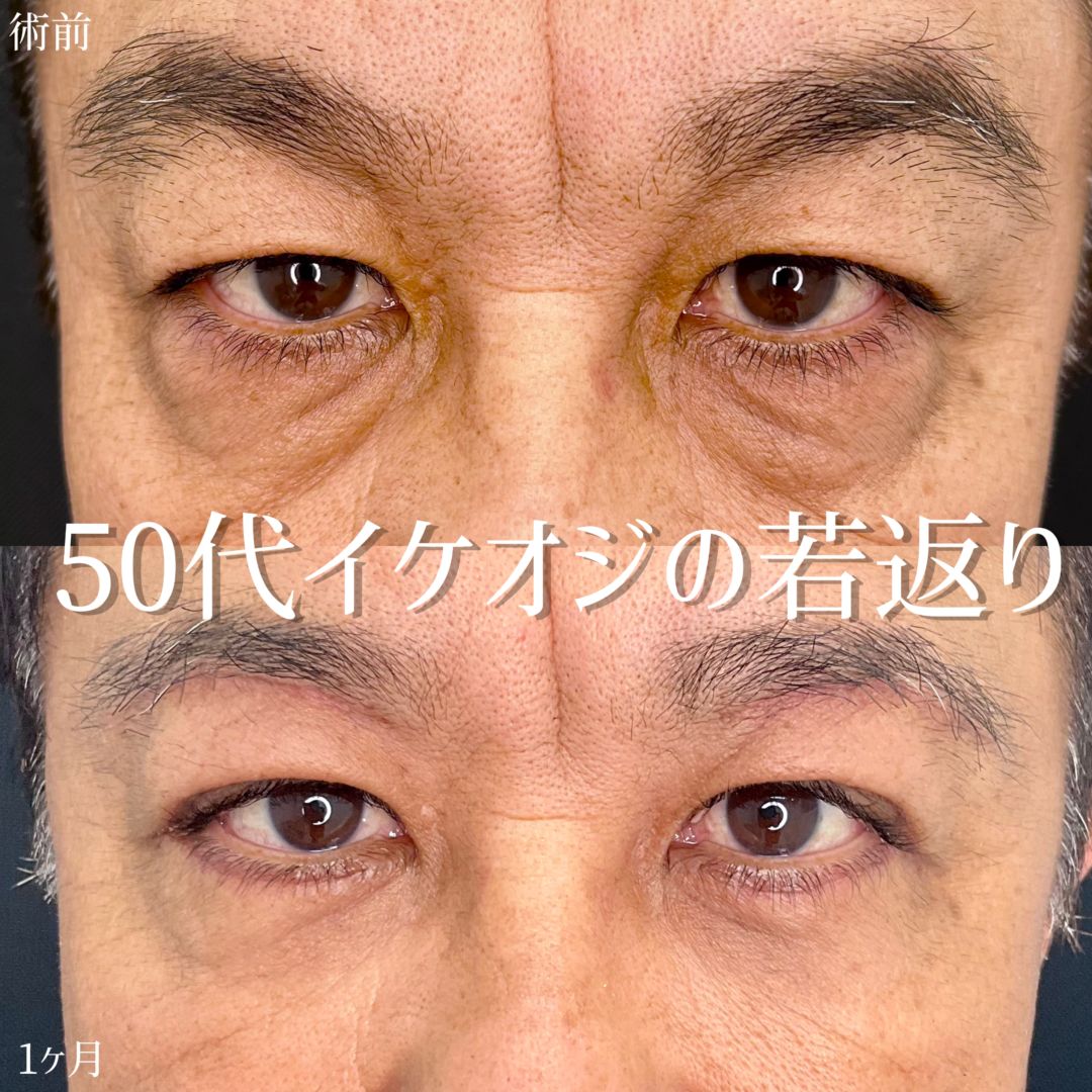 50代男性の眉下切開の症例