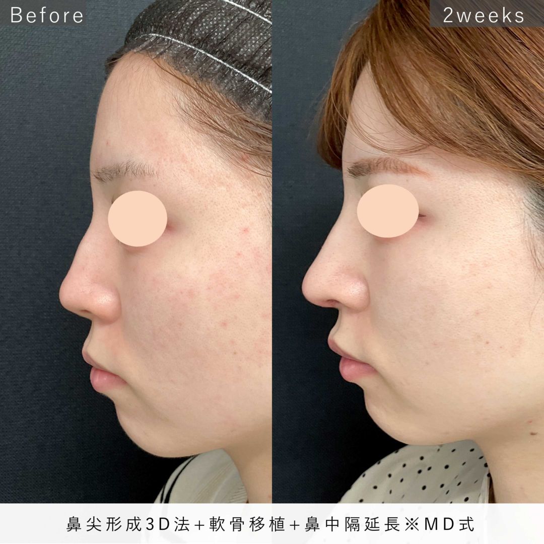 鼻尖形成と軟骨移植と鼻中隔延長の手術前と2週間後の症例写真