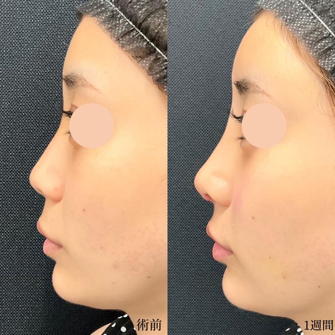 20代女性の鼻整形の症例