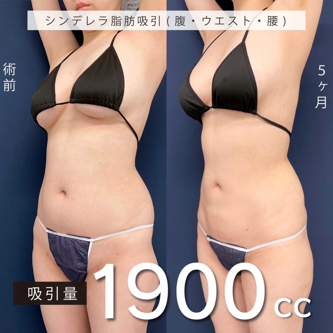 お腹の脂肪吸引の手術前と5か月後の症例写真