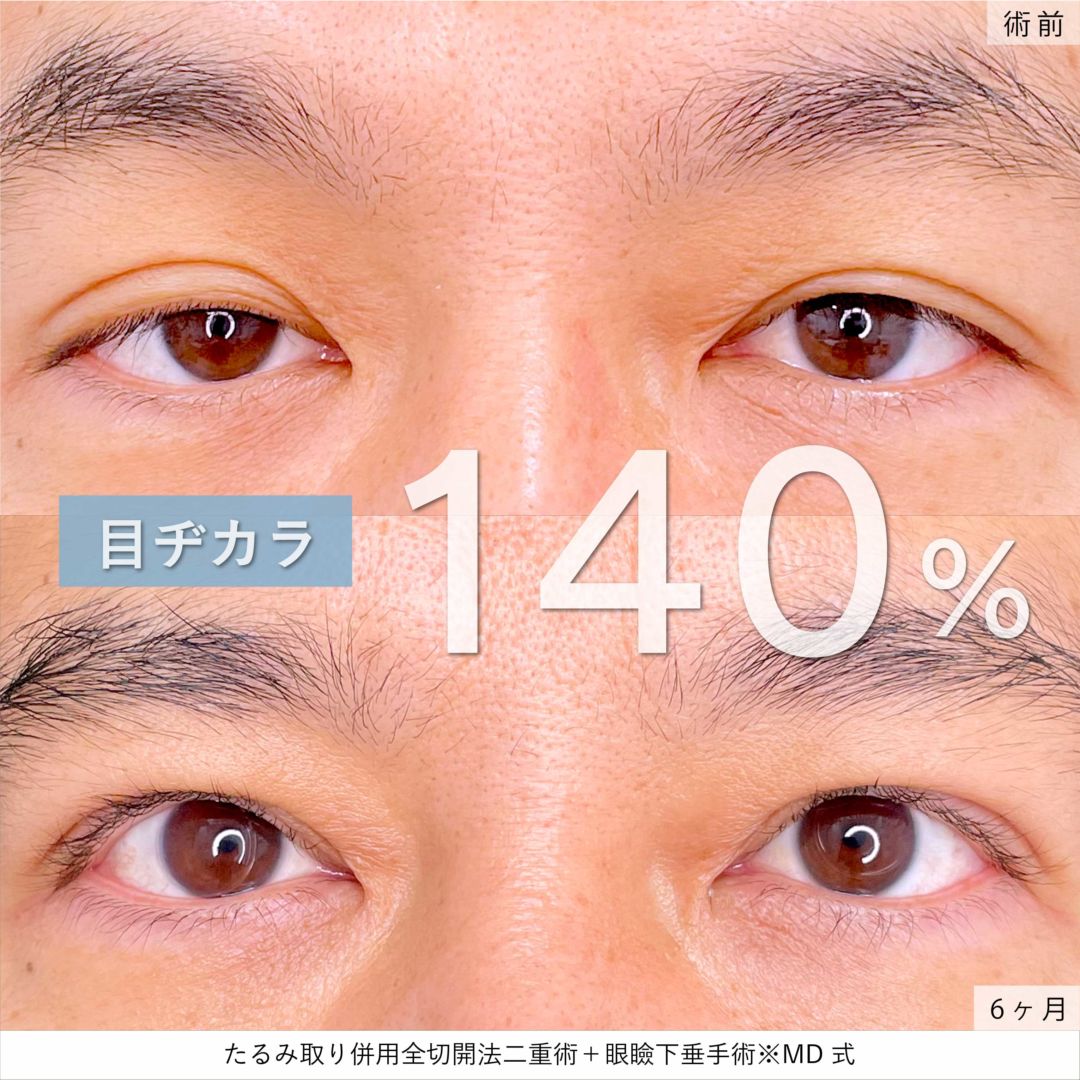 たるみ取り併用全切開法二重術と眼瞼下垂と他院修正を受けた40代男性の6ヶ月後の症例写真