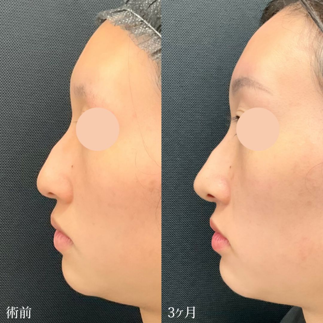 20代女性の鼻尖形成の症例