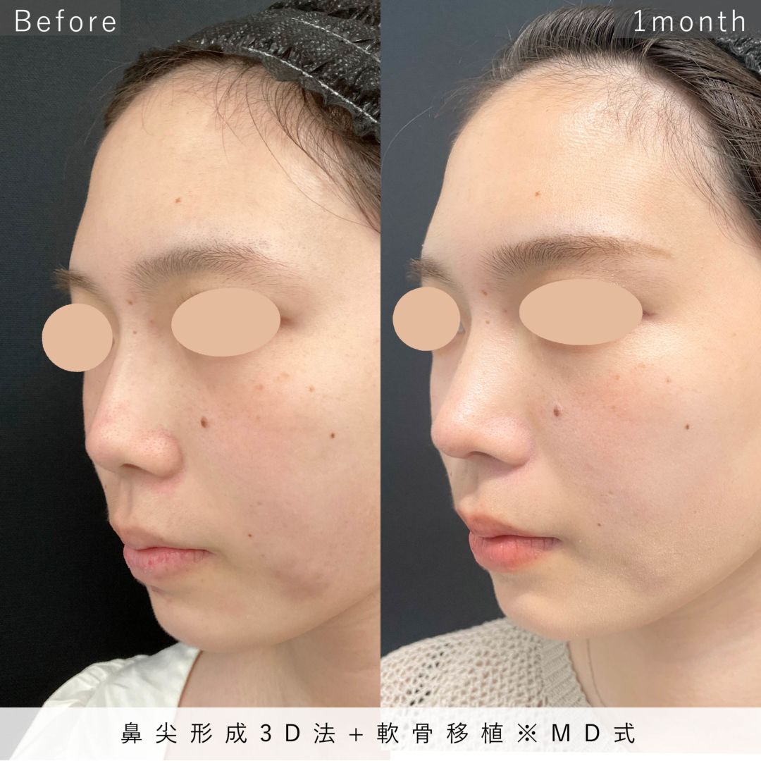 鼻尖形3D法と軟骨移植を受けた20代女性の1ヶ月後の症例写真