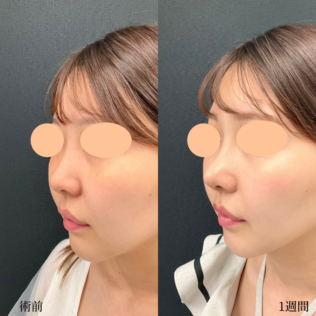 20代女性の鼻尖形成の症例