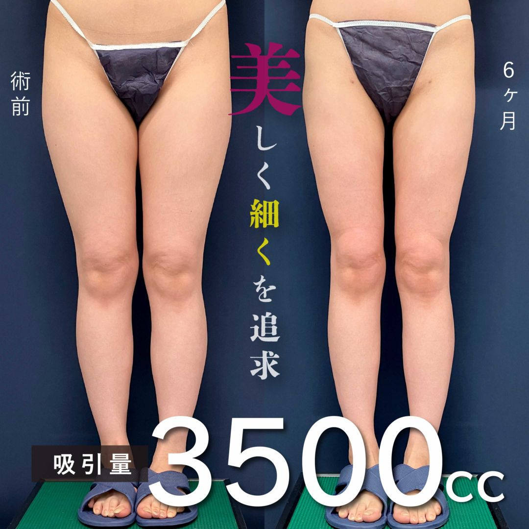 脚全体のアキーセル脂肪吸引とボツリヌス注射した６ヶ月の症例写真