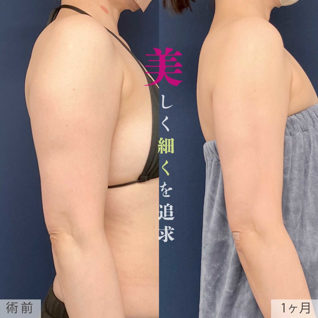 アキーセル脂肪吸引の二の腕と肩の１ヶ月後の症例
