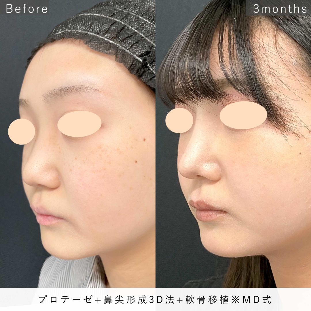 プロテーゼ+鼻尖形成3D法と軟骨移植をMD式で受けた20代女性の3ヶ月後の症例写真