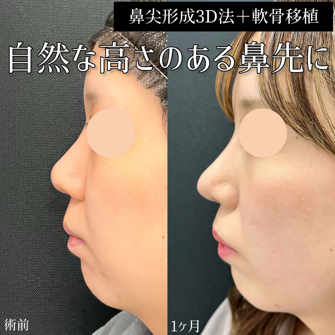 20代女性の鼻尖形成と軟骨移植の症例