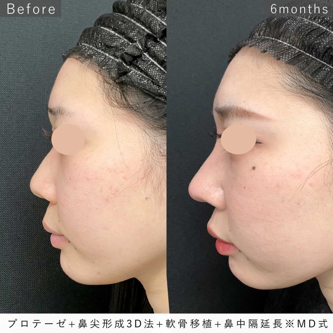 プロテーゼと鼻尖形成3D法と軟骨移植と鼻中隔延長をMD式で受けた6ヶ月後の症例写真