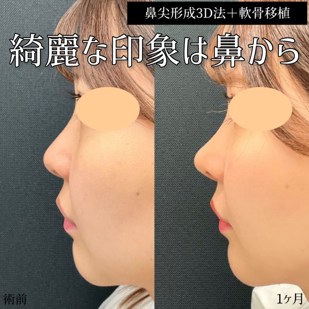 20代女性の鼻整形の症例
