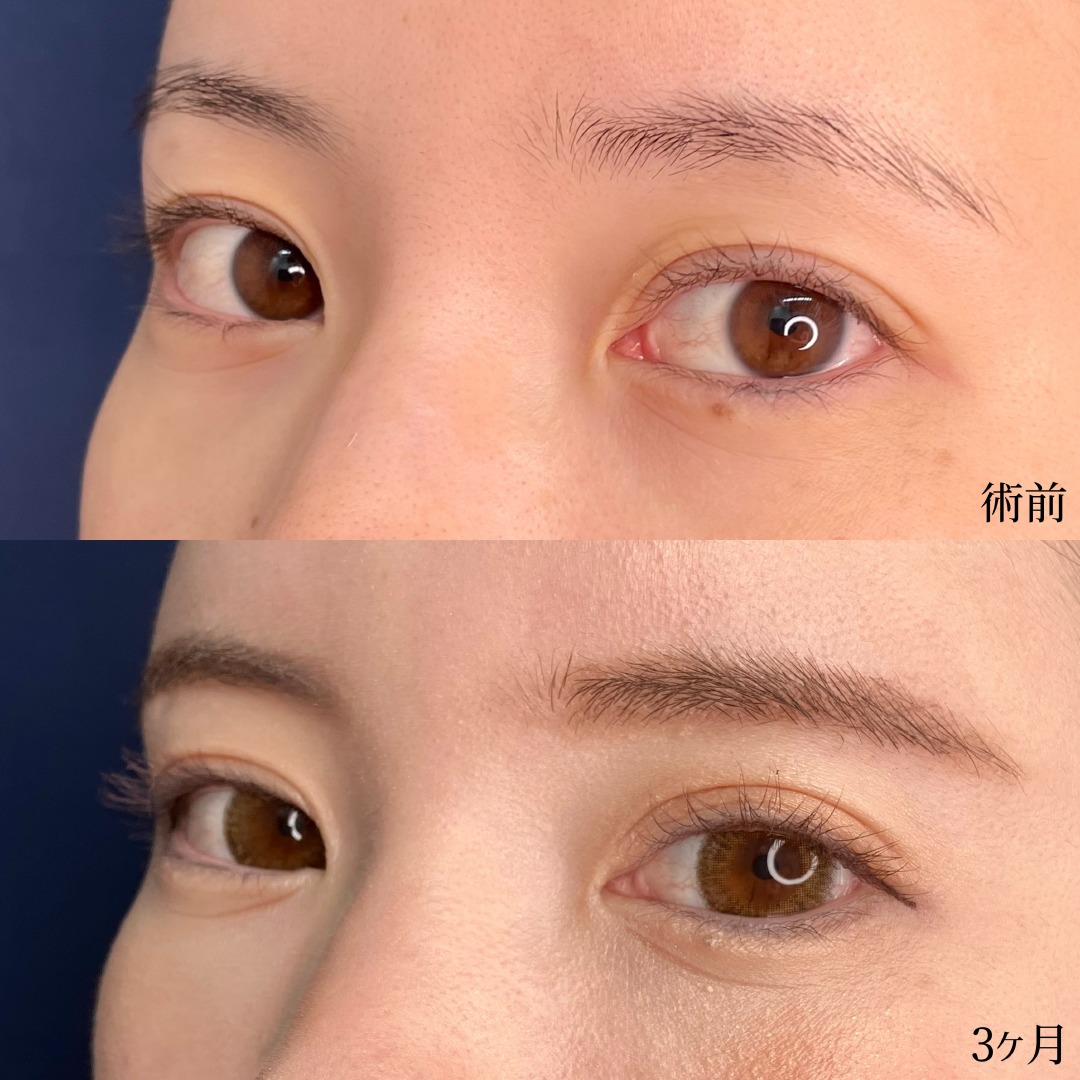眉下切開の手術前と3ヶ月後の症例写真