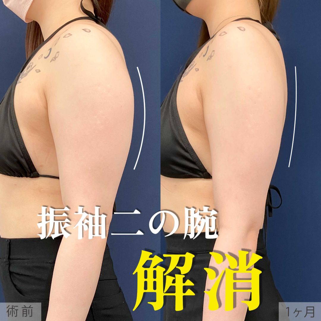 二の腕と肩をアキーセル脂肪吸引した20代女性。1ヶ月の症例