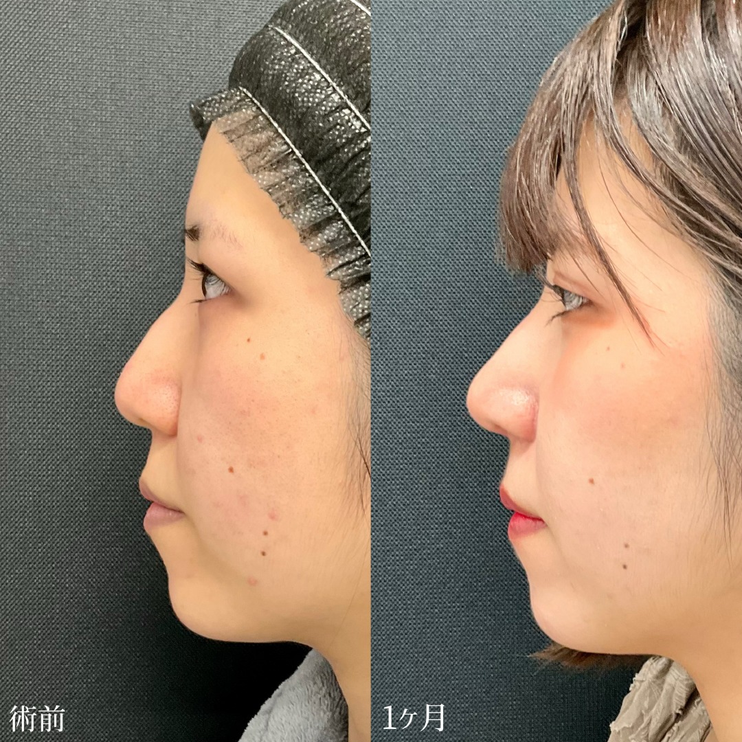 20代女性のわし鼻修正の症例