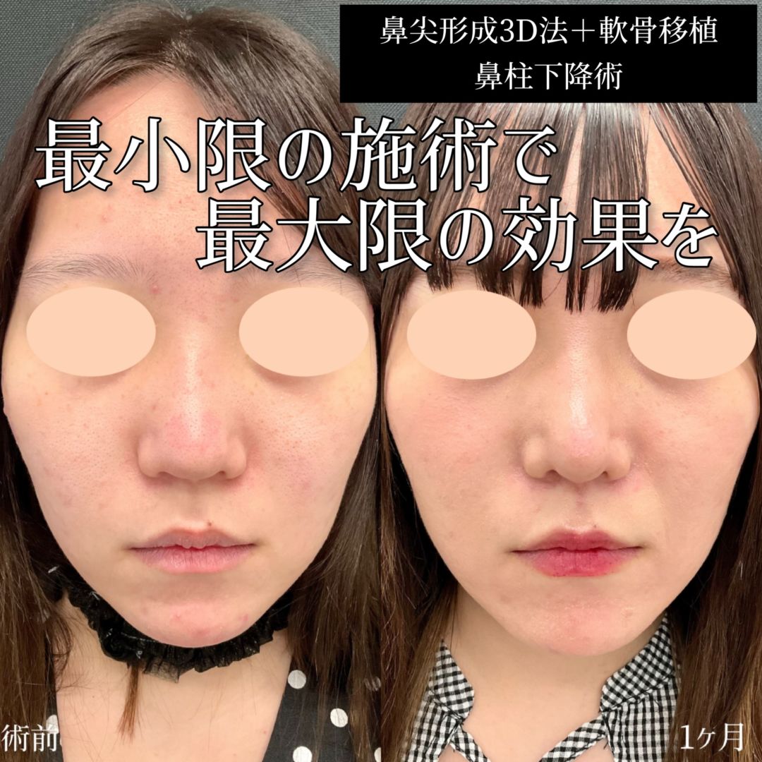 鼻柱下降術 の症例写真一覧|新宿と池袋の美容整形は東京シンデレラ美容外科