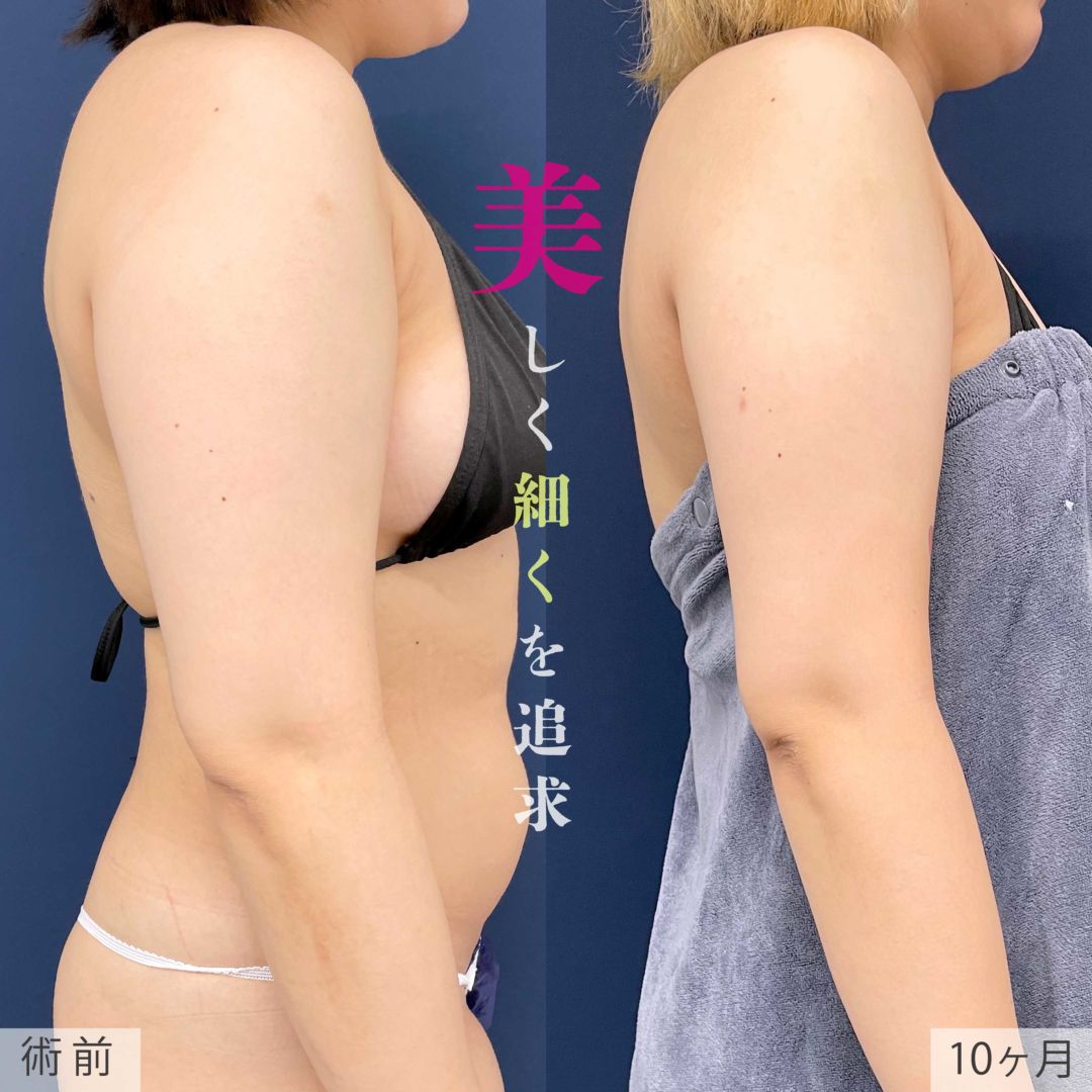 シンデレラ脂肪吸引で二の腕と肩がスッキリ変化