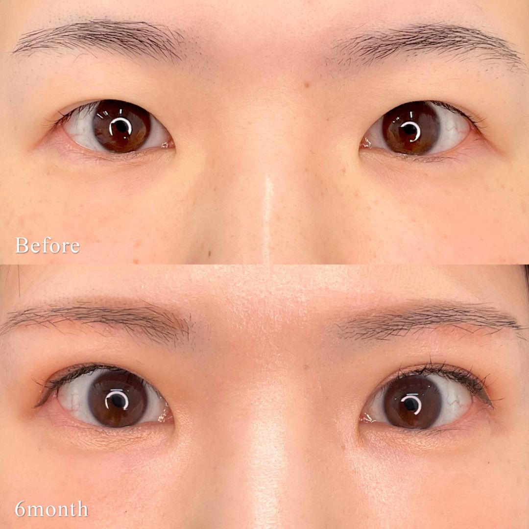 眼瞼下垂の手術前と6ヶ月後の症例写真