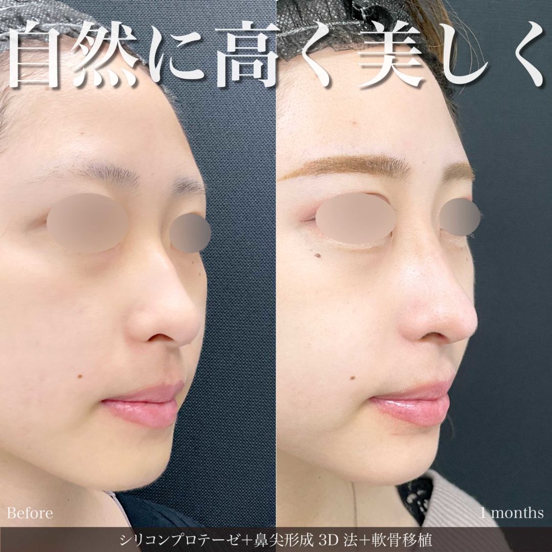 プロテーゼと鼻尖形成3D法と軟骨移植を受けた20代女性の症例写真