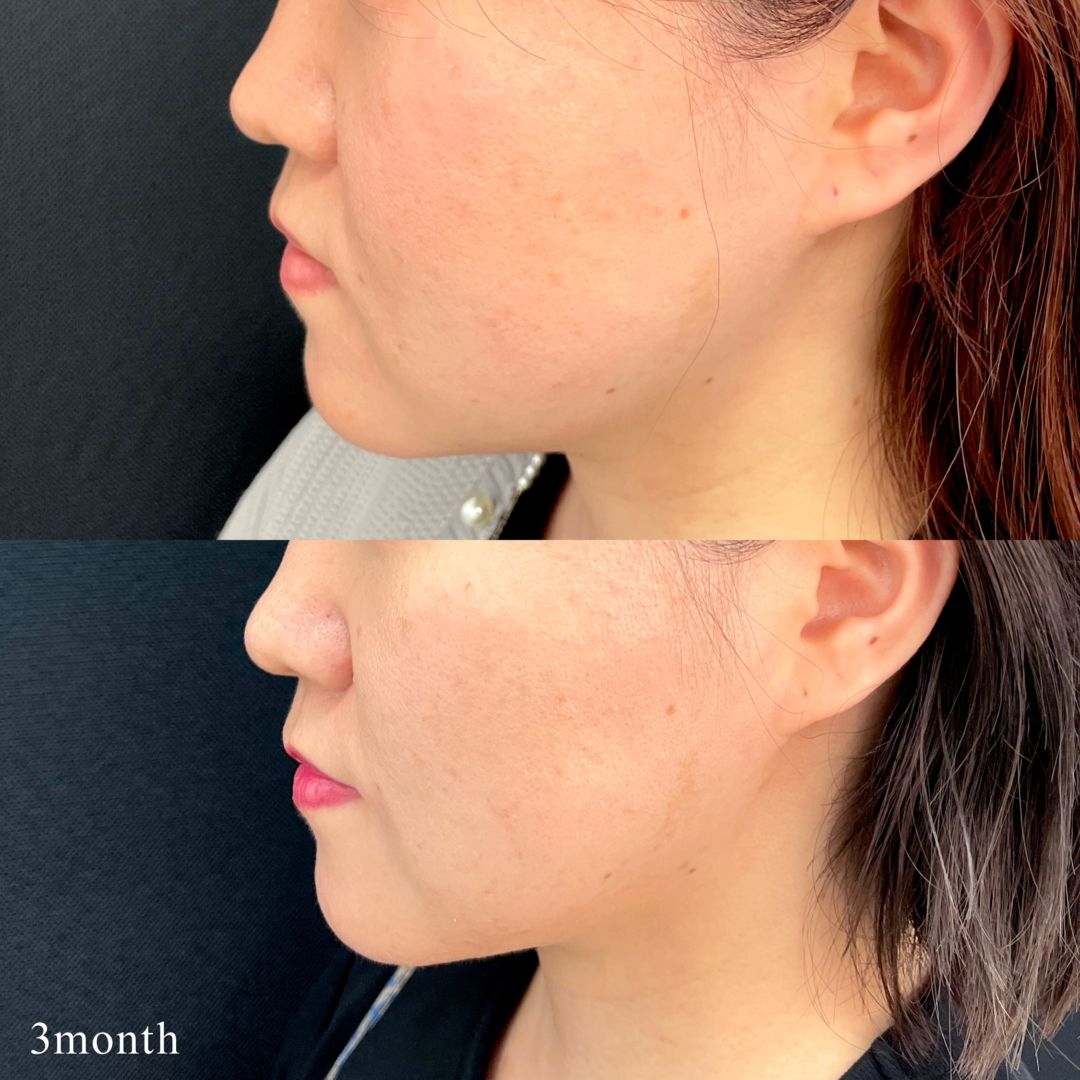 小顔脂肪吸引の手術前と3ヶ月後の症例写真