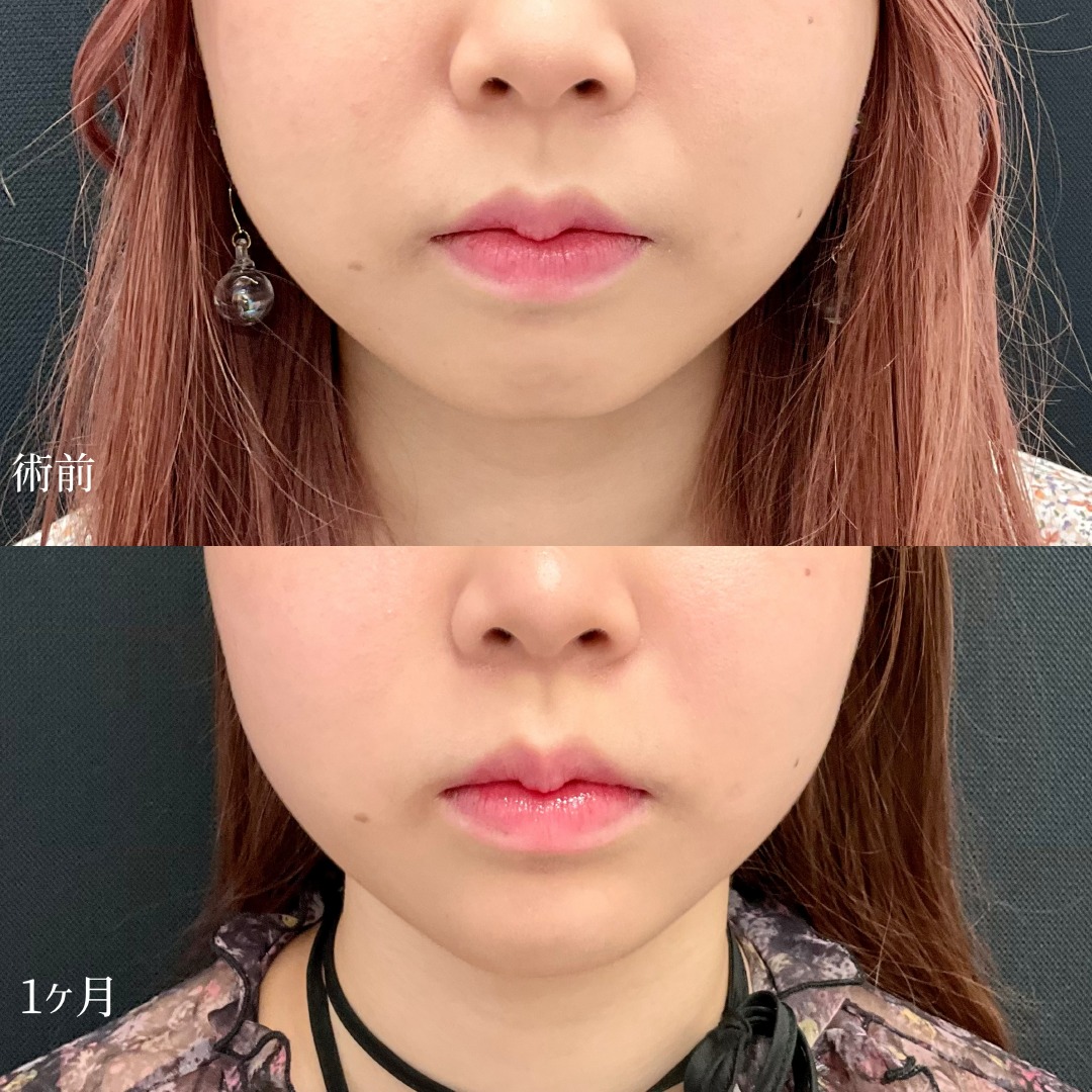 10代女性の顎ヒアルロン酸の症例