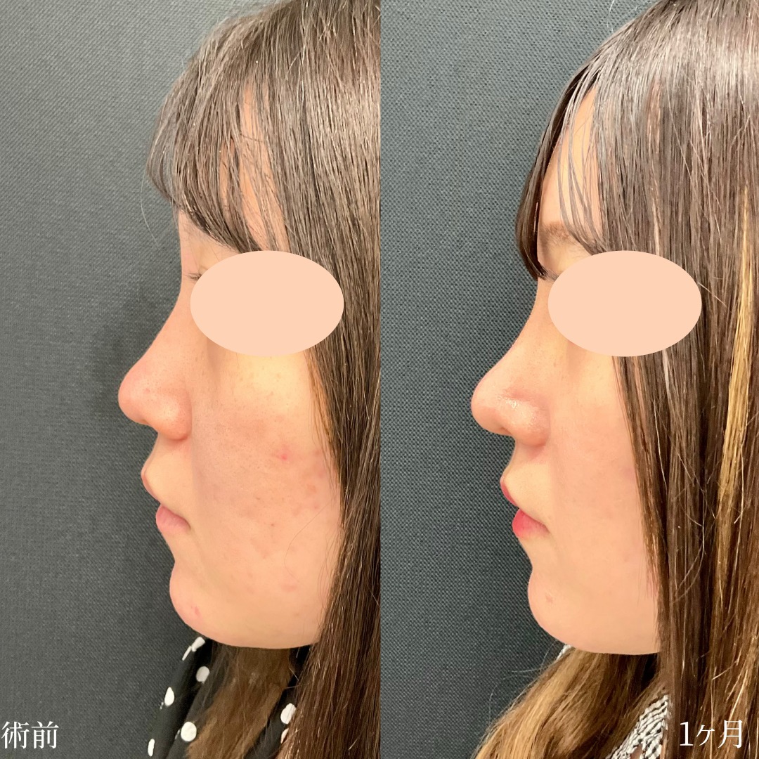 鼻柱下降術 の症例写真一覧|新宿と池袋の美容整形は東京シンデレラ美容外科