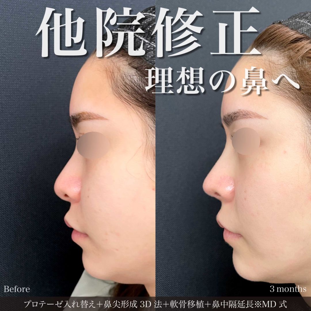 プロテーゼ入れ替えと鼻尖形成3D法と軟骨移植と鼻中隔延長をMD式で受けた女性の症例
