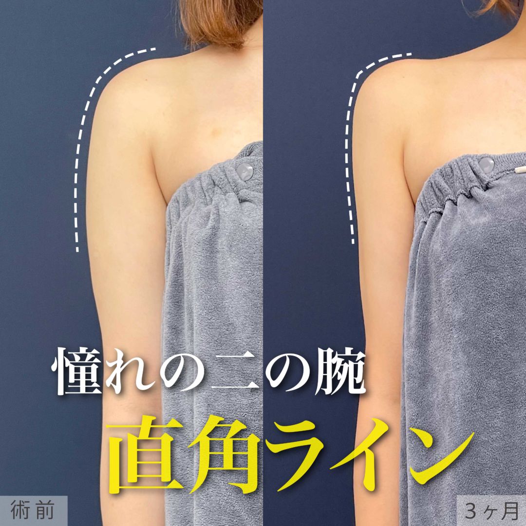 二の腕と肩をアキーセル脂肪吸引して韓国風直角肩になった20代女性の症例