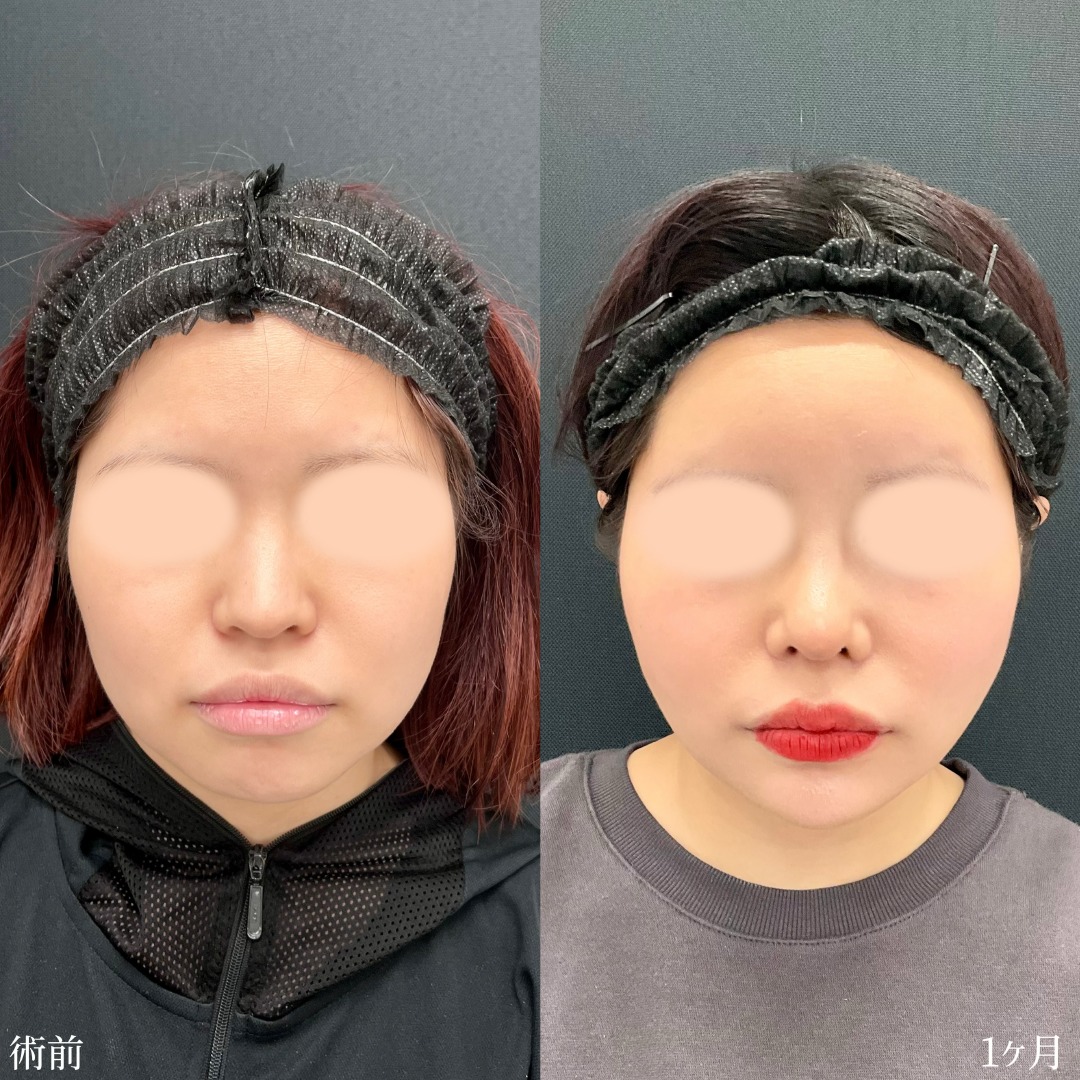 20代女性の鼻整形と小顔整形の症例