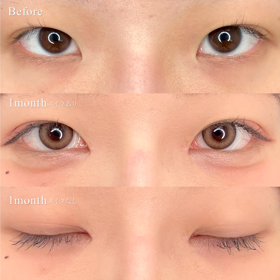 目頭切開とタレ目形成の術前と術後1ヶ月の症例写真