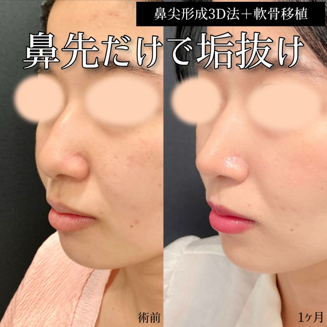 20代女性の鼻整形の症例