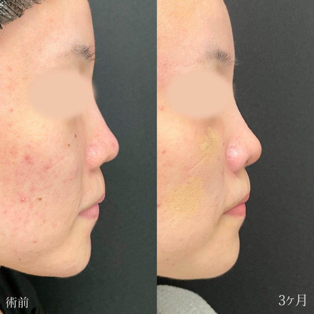 20代女性の鼻整形の症例
