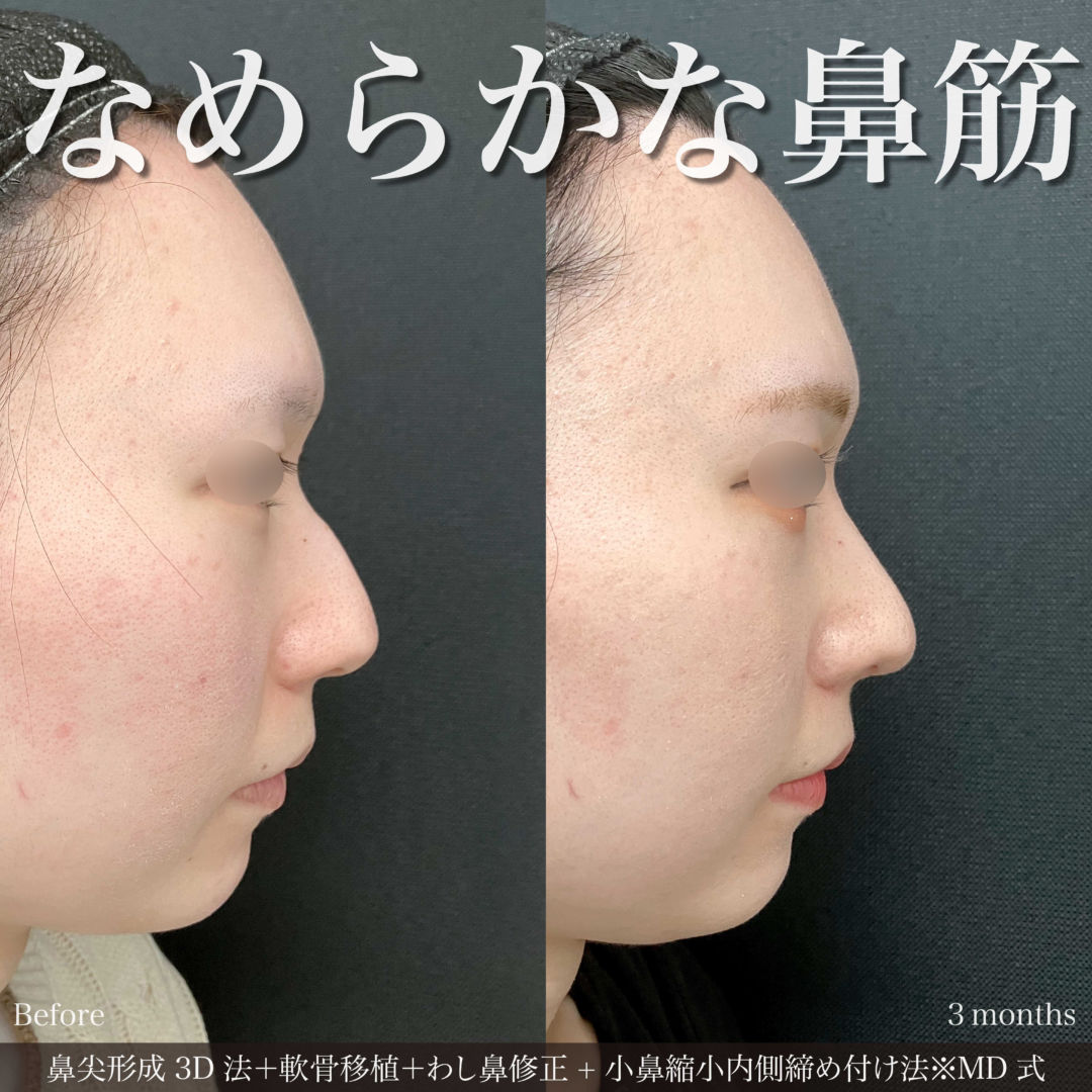 鼻尖形成3D法と軟骨移植とわし鼻修正と小鼻縮小内側締め付け法をMD式で受けた女性の症例写真