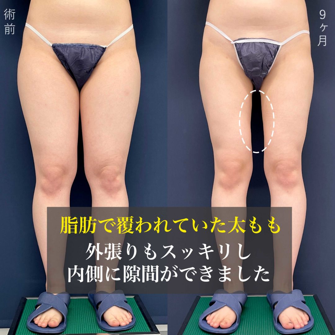 アキーセル脂肪吸引とボトックスでお尻と脚が激痩せした20代女性の症例写真