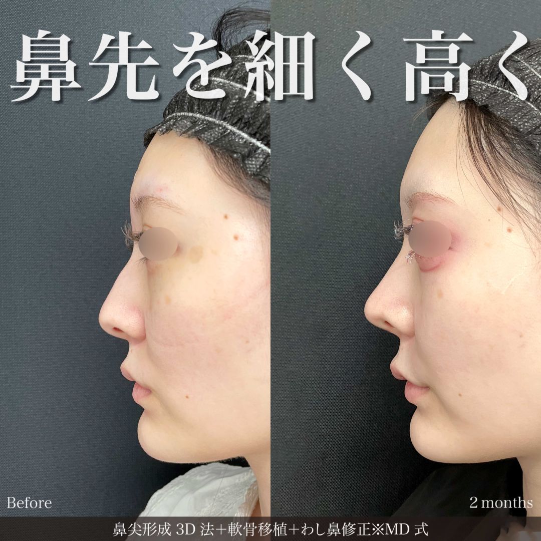 鼻尖形成3D法と軟骨移植とわし鼻修正をMD式で受けた女性の症例