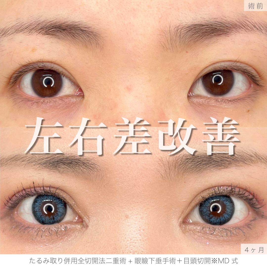 たるみ取り併用全切開法二重術と眼瞼下垂手術と目頭切開をMDで受けた女性の症例写真