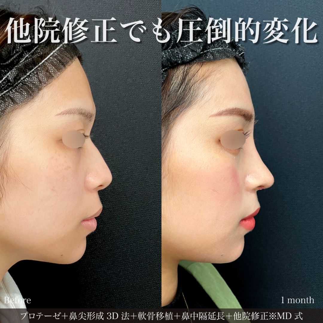 プロテーゼと鼻尖形成3D法と軟骨移植と鼻中隔延長と他院修正をMD式で受けた女性の症例写真