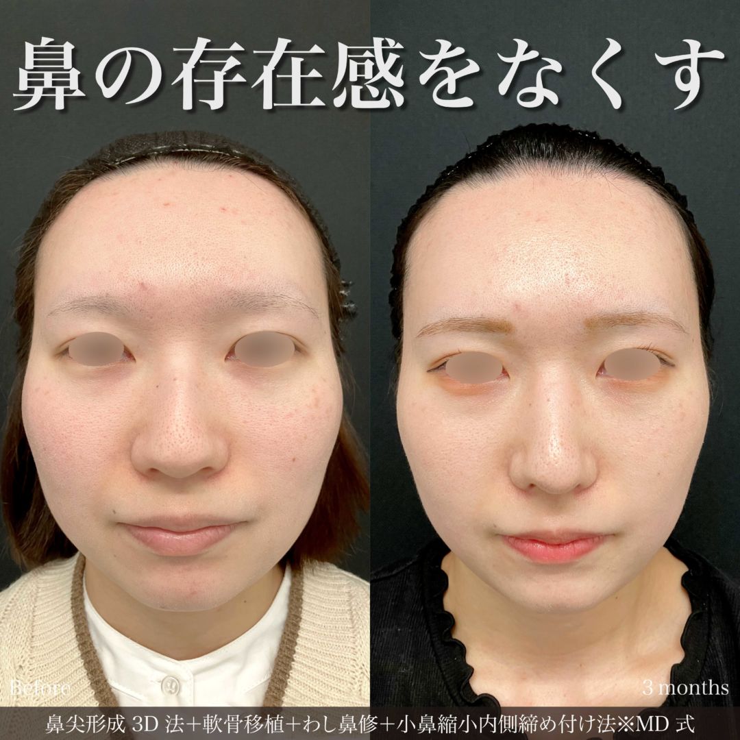 鼻尖形成3D法と軟骨移植と小鼻縮小内側締め付け法をMD式で受けた20代女性の症例写真