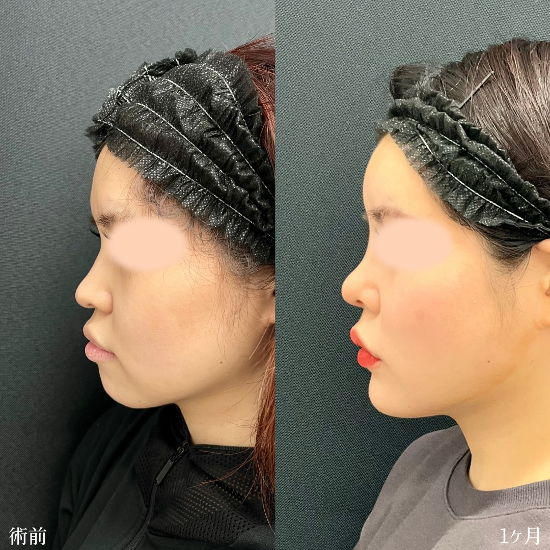 20代女性のプロテーゼ鼻尖形成3D法軟骨移植の症例