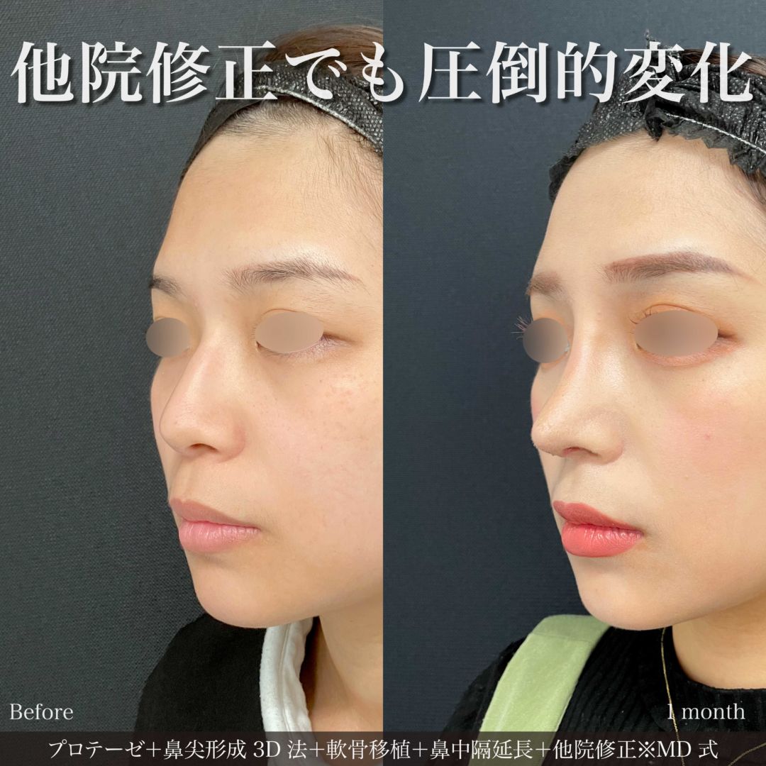 プロテーゼと鼻尖形成3D法と軟骨移植と鼻中隔延長と他院修正をMD式で受けた女性の症例写真